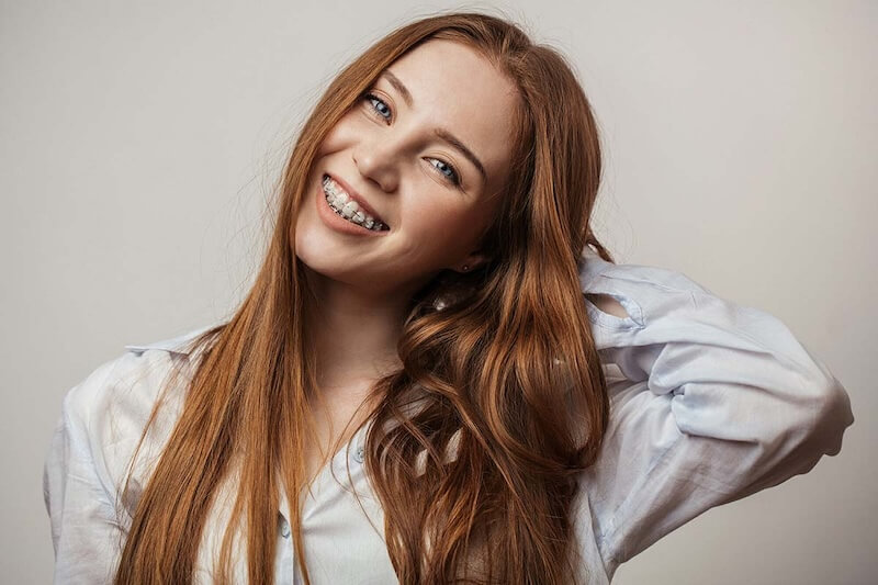 Clear Aligners