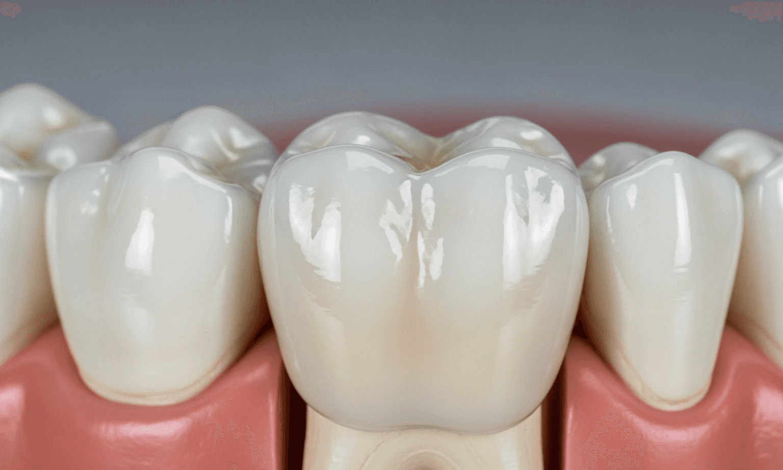 A detailed image of a porcelain dental crown placed on a molar model, showing its natural appearance and how it encapsulates the tooth. - Cracked tooth solutions