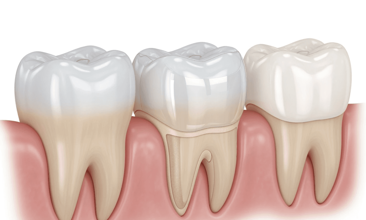Illustration showing a natural tooth, a tooth prepared for a veneer with a thin layer of enamel removed, and a tooth with a veneer bonded to its surface - Permanent veneers cost